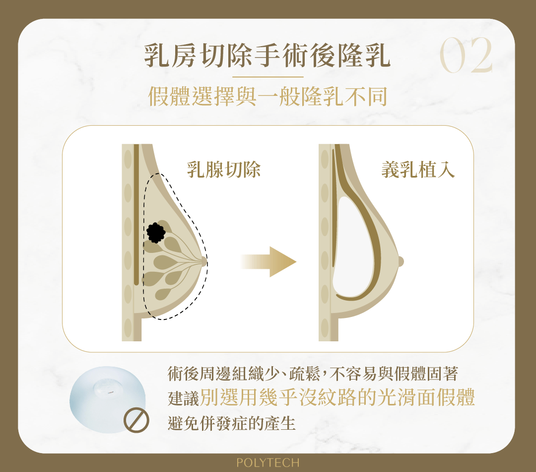 何時需「預防性乳房切除」?該怎麼做隆乳重建手術? 預防性乳房切除 隆乳 假體選擇