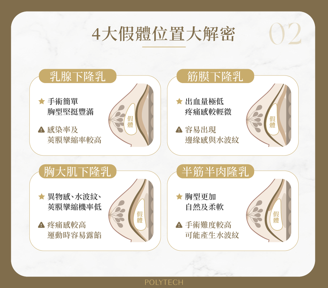 隆乳假體放哪裡?4種手術置放位置大不同! 隆乳假體 手術置放常見位置